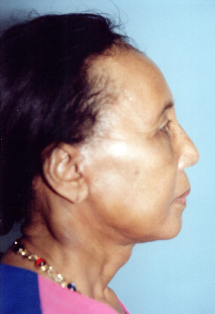 After Image: Face-Neck Lift - right-side