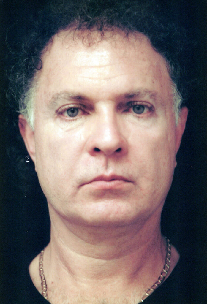 Before Image: Face-Neck Lift - front