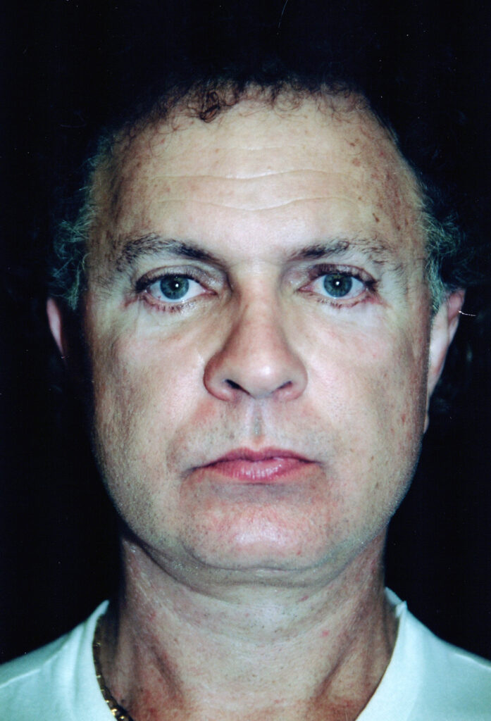 After Image: Face-Neck Lift - front