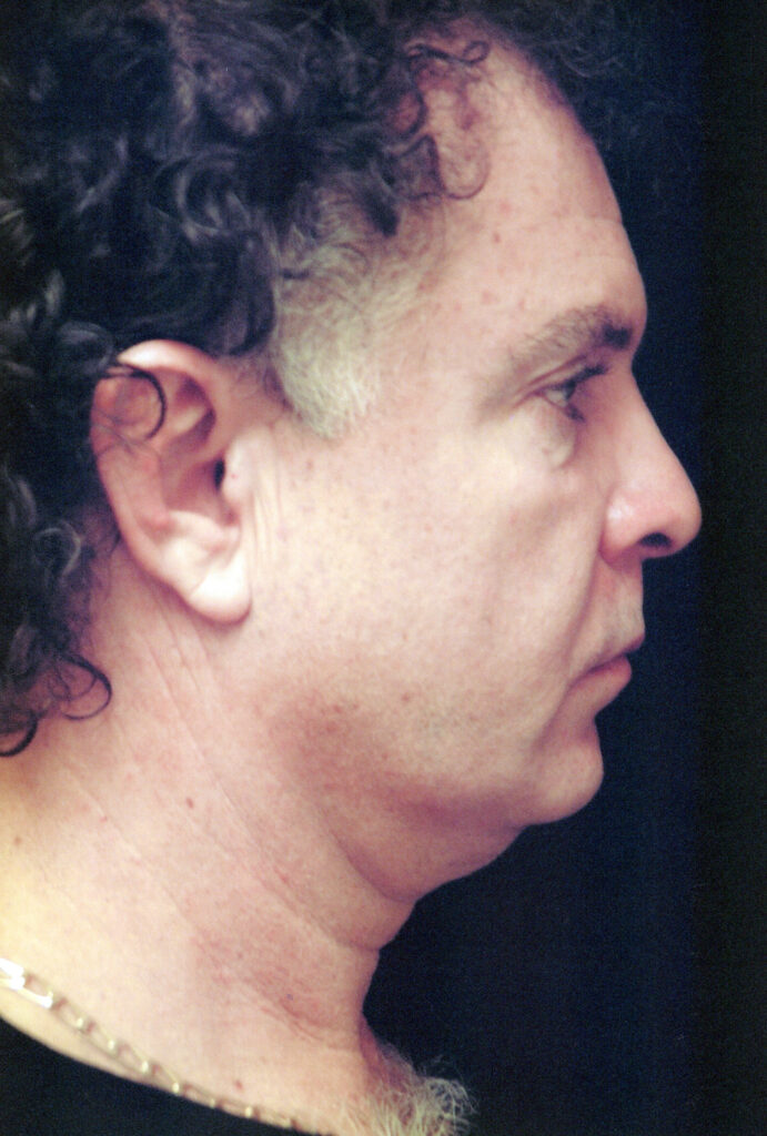 Before Image: Face-Neck Lift - right-side