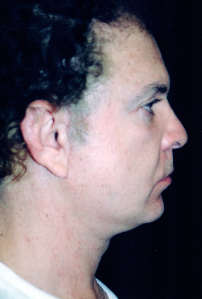 After Image: Face-Neck Lift - right-side