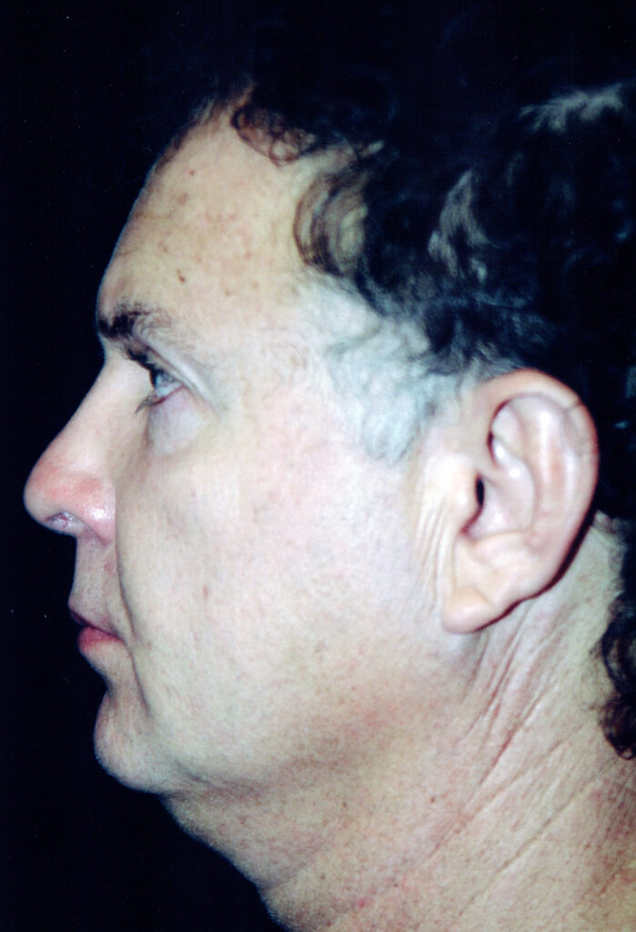 Before Image: Face-Neck Lift - left-side