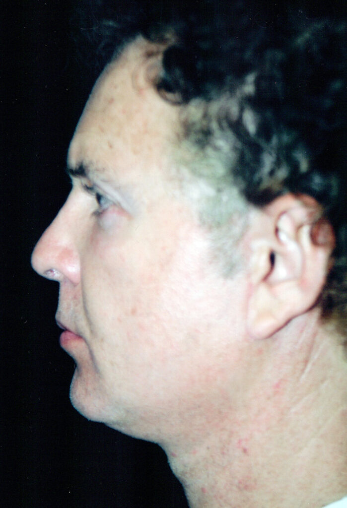 After Image: Face-Neck Lift - left-side