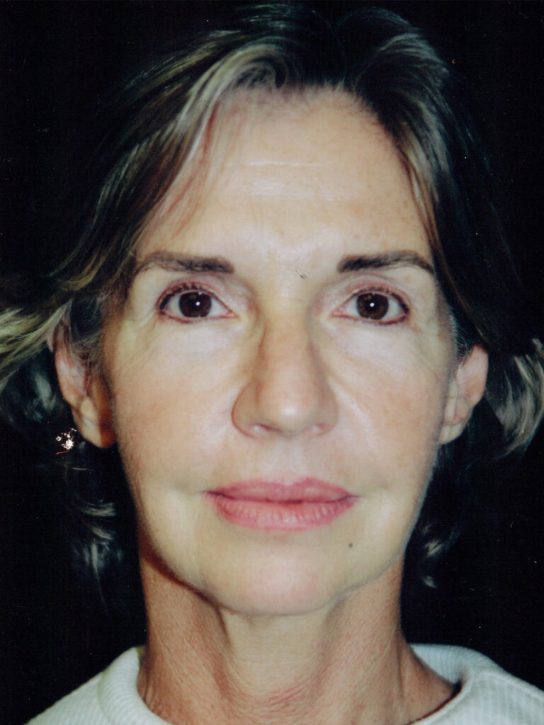 Before Image: Face-Neck Lift - front