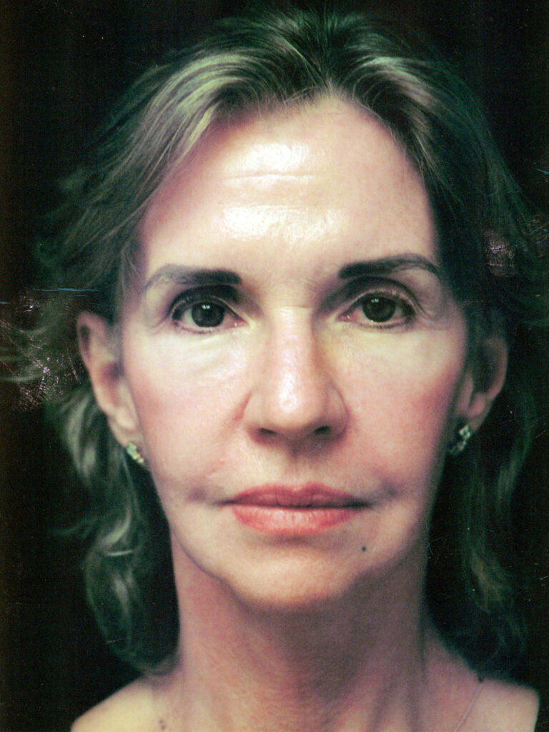 After Image: Face-Neck Lift - front