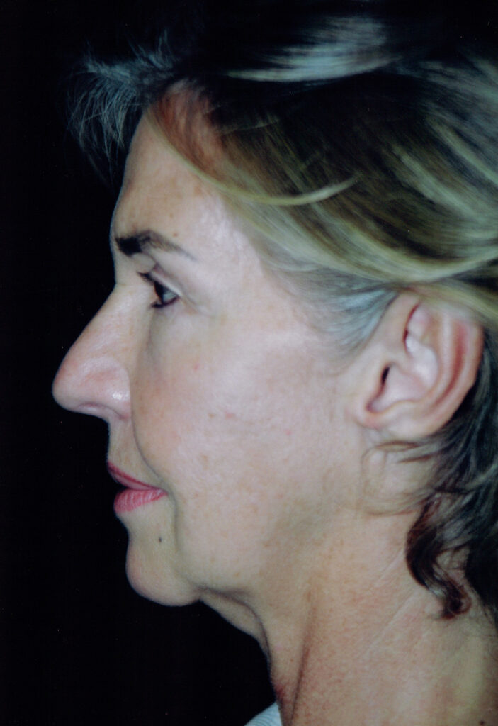 Before Image: Face-Neck Lift - left-side
