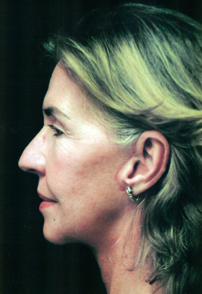 After Image: Face-Neck Lift - left-side