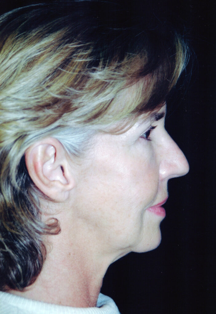 Before Image: Face-Neck Lift - right-side