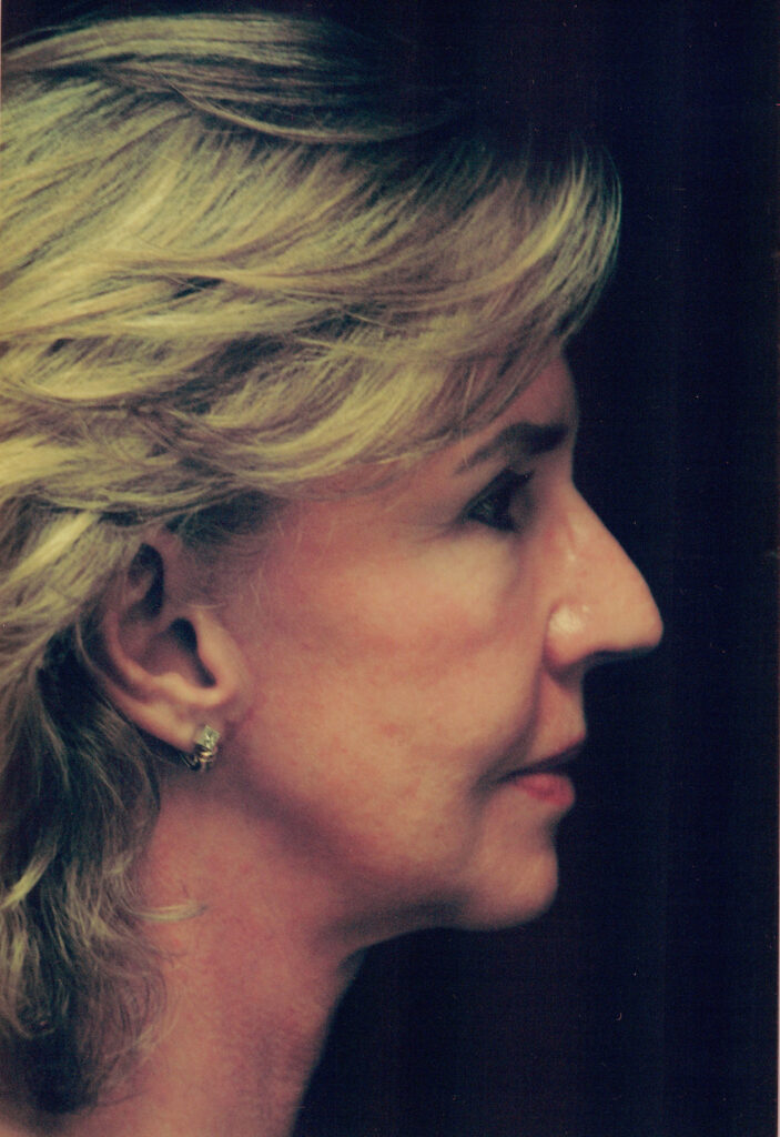 After Image: Face-Neck Lift - right-side