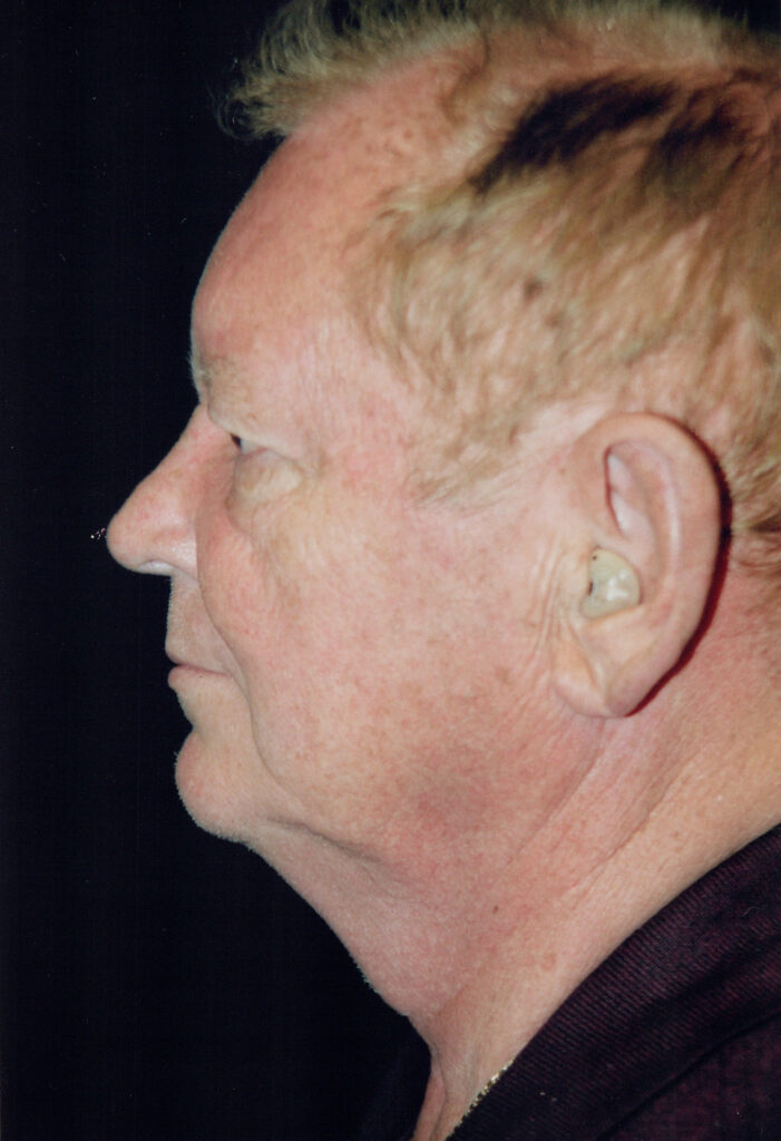 Before Image: Face-Neck Lift - left-side