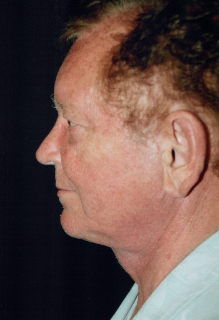 After Image: Face-Neck Lift - left-side