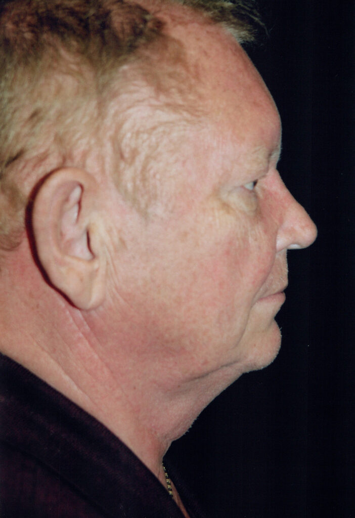 Before Image: Face-Neck Lift - right-side