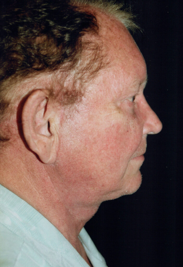 After Image: Face-Neck Lift - right-side