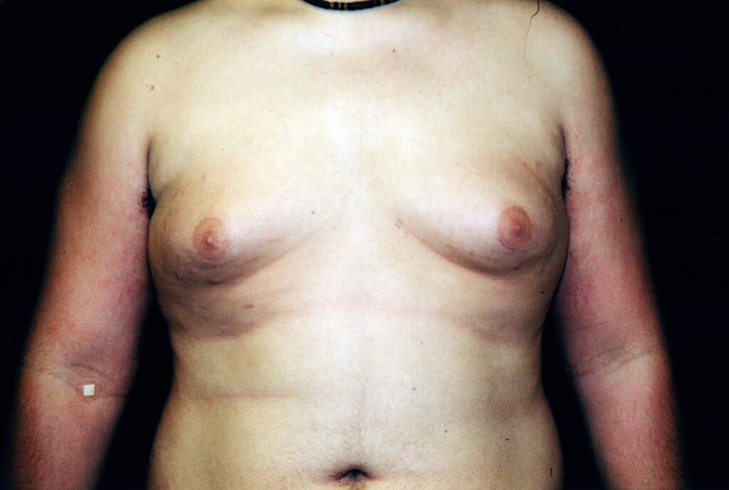 Before Image: Gynecomastia - front