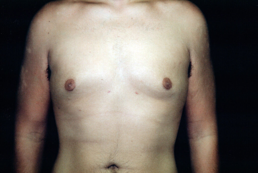 After Image: Gynecomastia - front