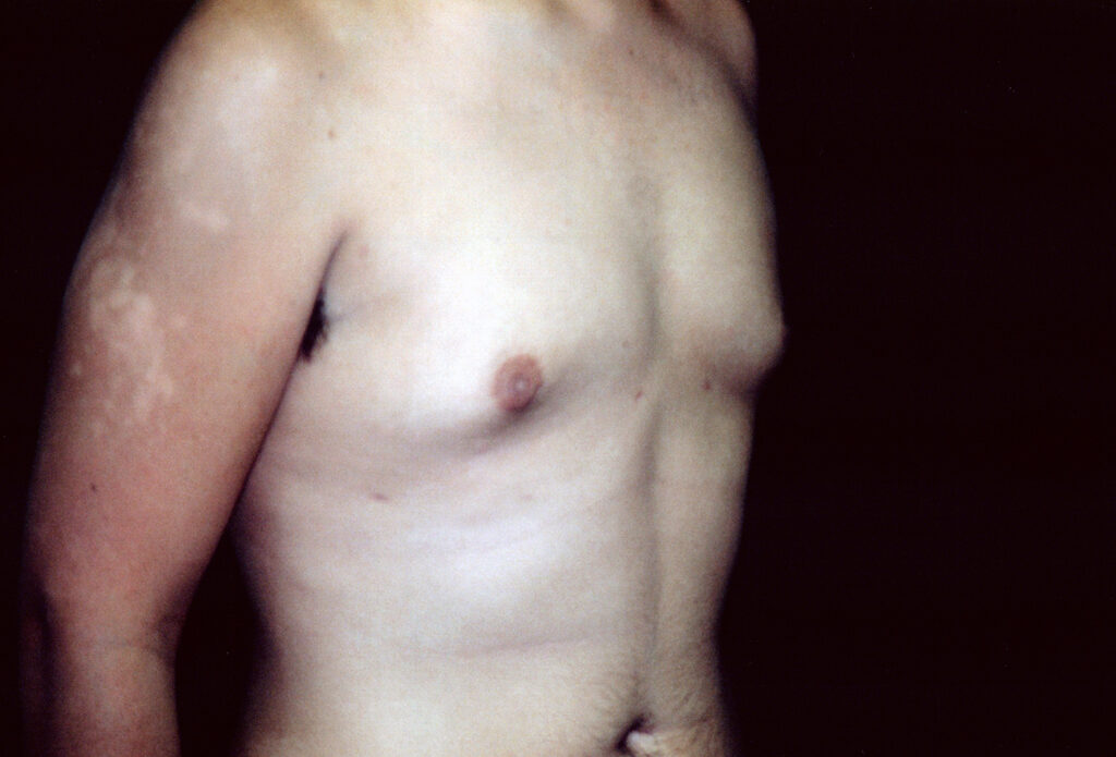 After Image: Gynecomastia - right-front-oblique