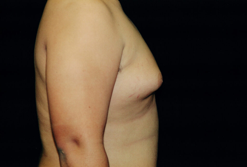 Before Image: Gynecomastia - right-side