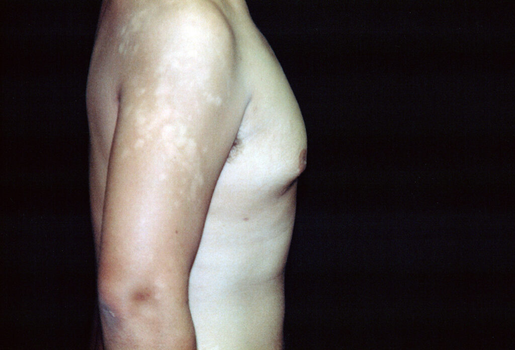 After Image: Gynecomastia - right-side