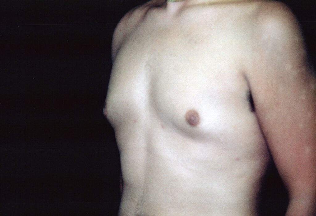 After Image: Gynecomastia - left-front-oblique