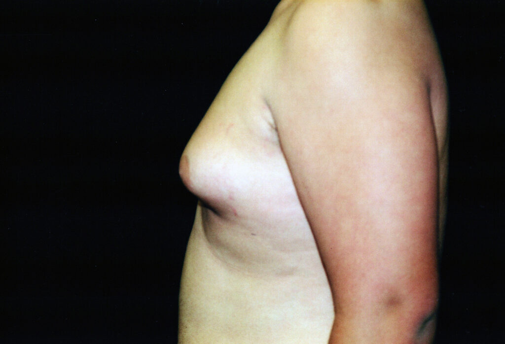 Before Image: Gynecomastia - left-side