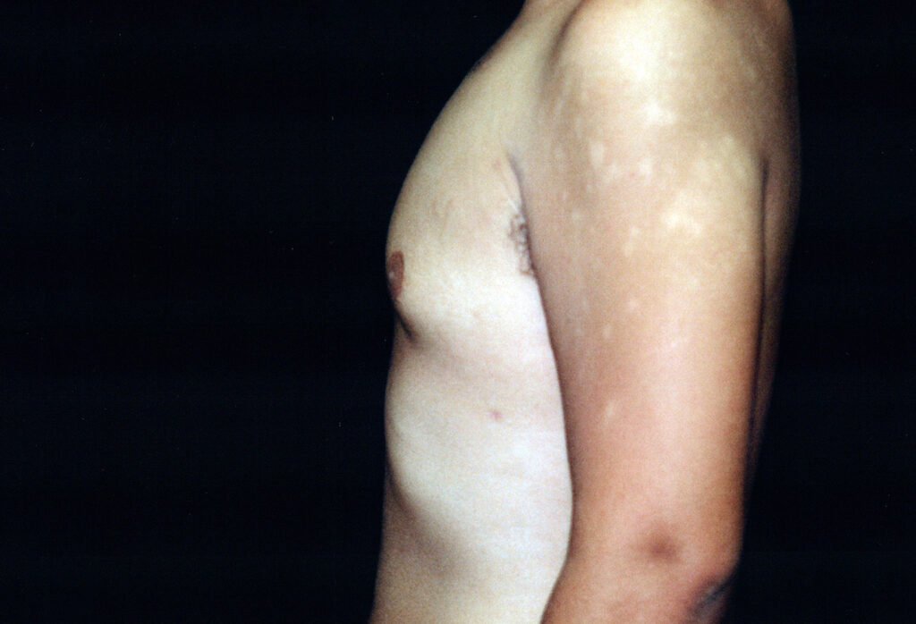 After Image: Gynecomastia - left-side
