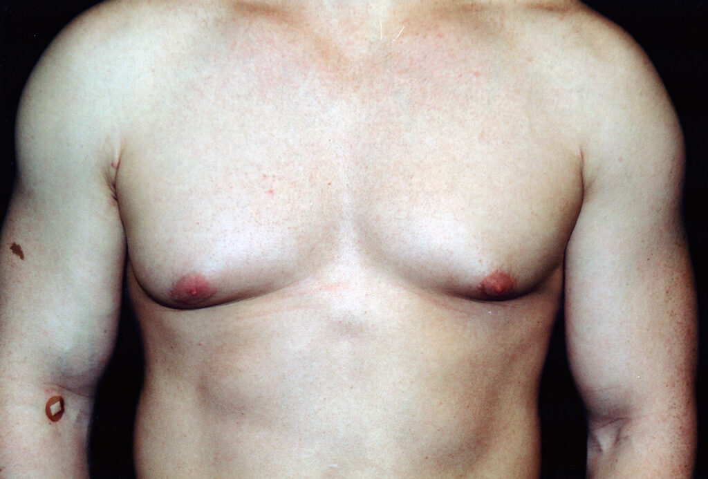 Before Image: Gynecomastia - front