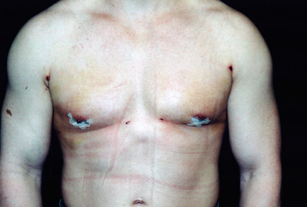 After Image: Gynecomastia - front