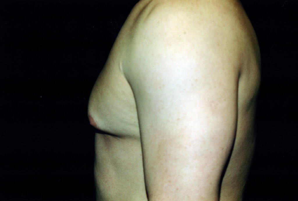 Before Image: Gynecomastia - left-side
