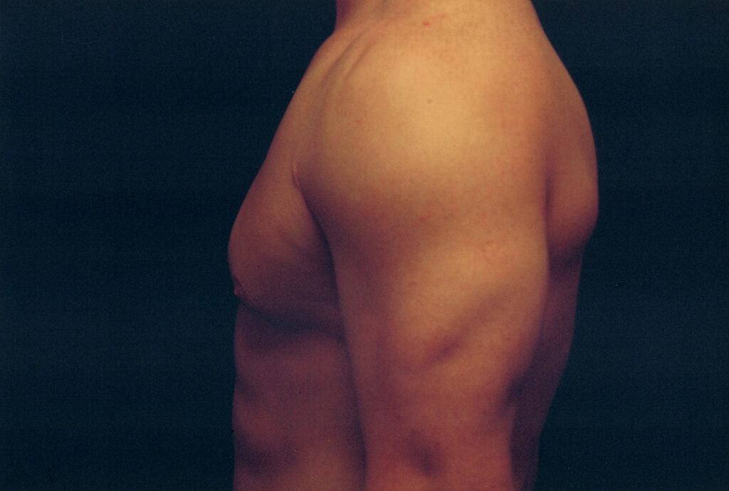 After Image: Gynecomastia - left-side