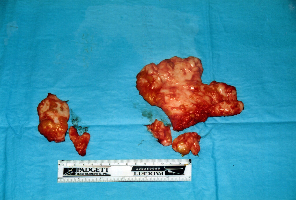 After Image: Gynecomastia - front