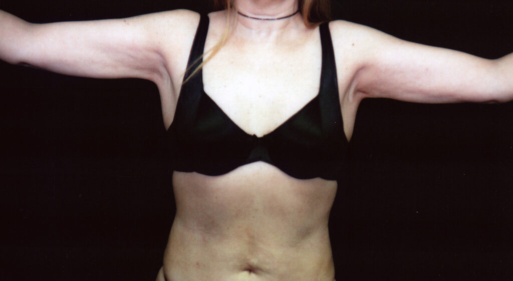 After Image: Liposuction - front
