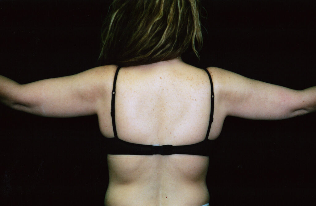 Before Image: Liposuction - back