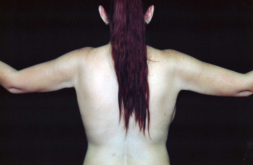 After Image: Liposuction - back