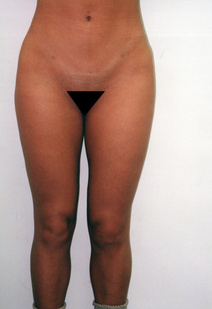 Before Image: Liposuction - front