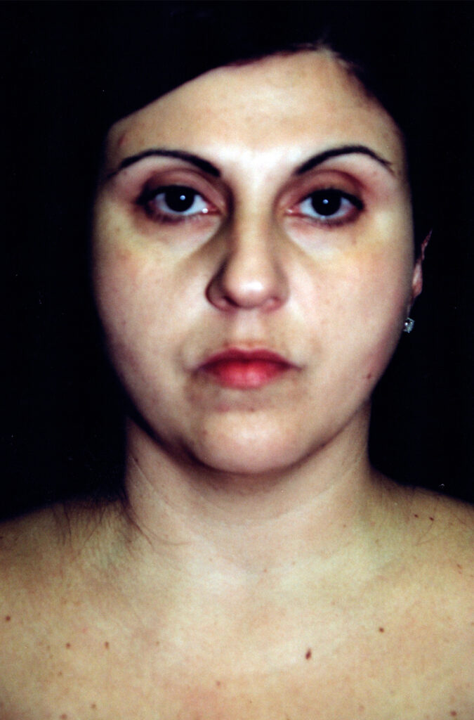 Before Image: Neck Liposuction - front