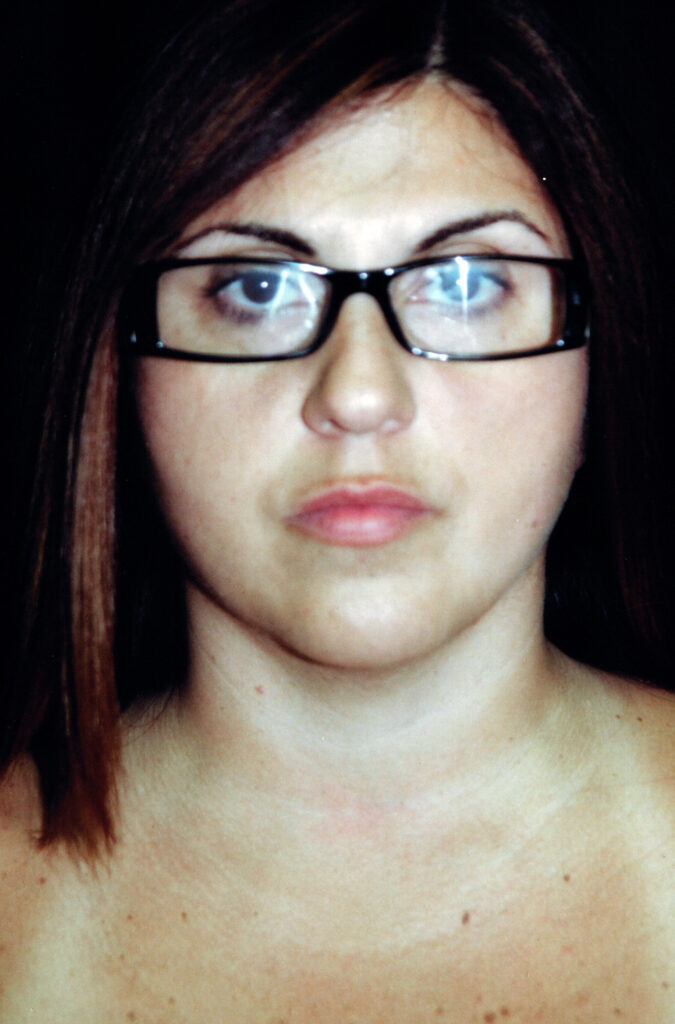 After Image: Neck Liposuction - front