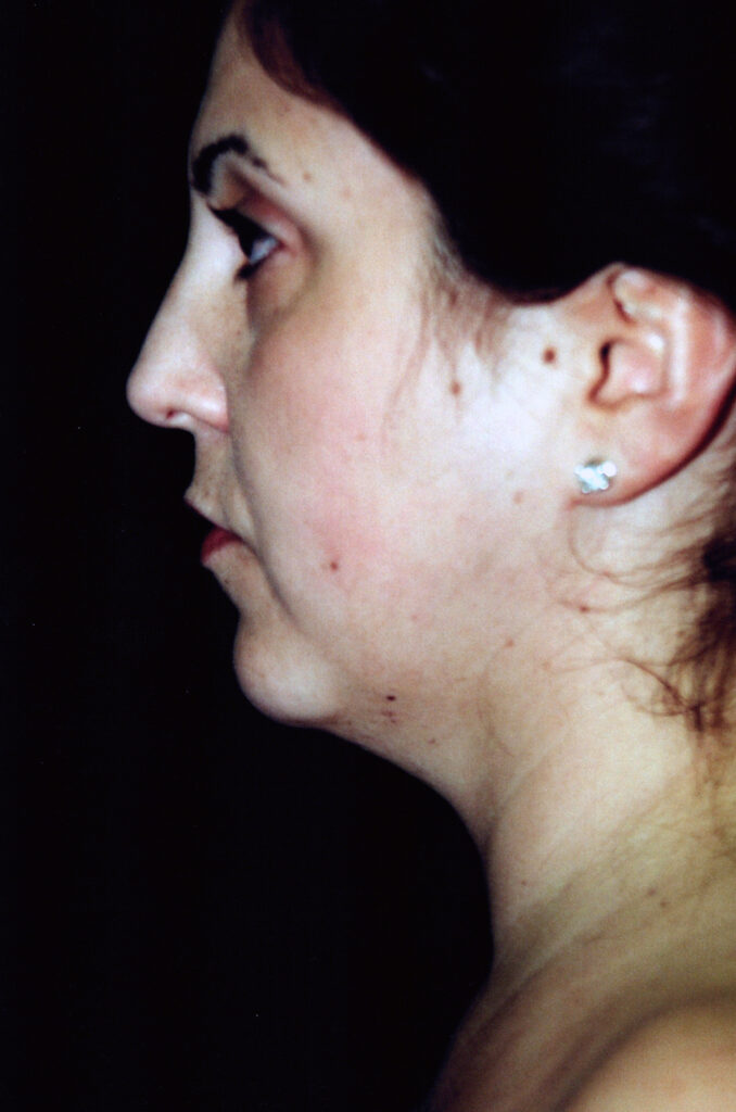 Before Image: Neck Liposuction - left-side