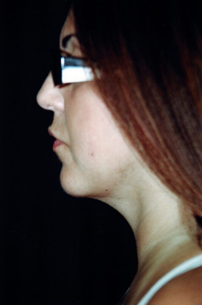 After Image: Neck Liposuction - left-side