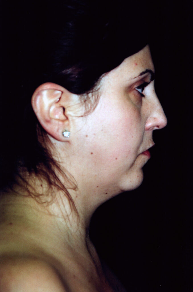 Before Image: Neck Liposuction - right-side