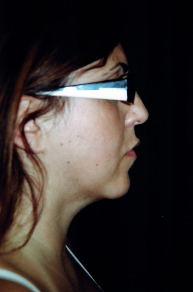After Image: Neck Liposuction - right-side