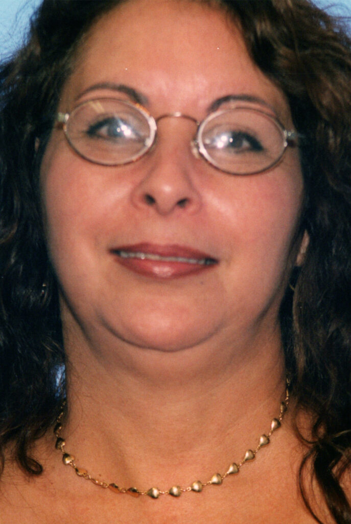 Before Image: Neck Liposuction - front