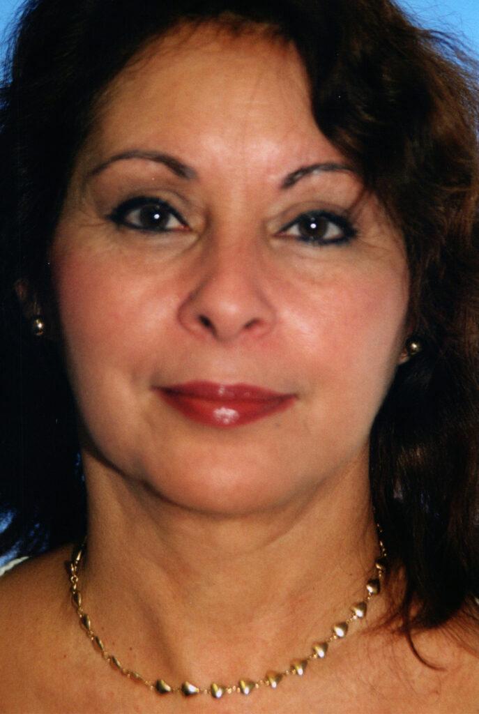 After Image: Neck Liposuction - front