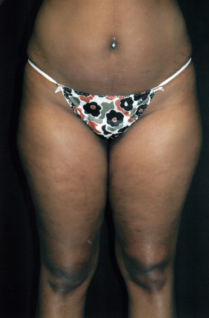Before Image: Liposuction - front