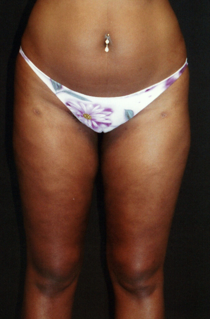 After Image: Liposuction - front