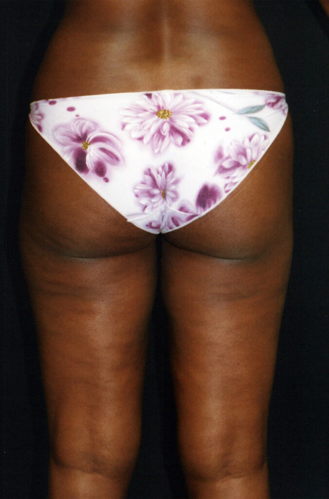 After Image: Liposuction - back