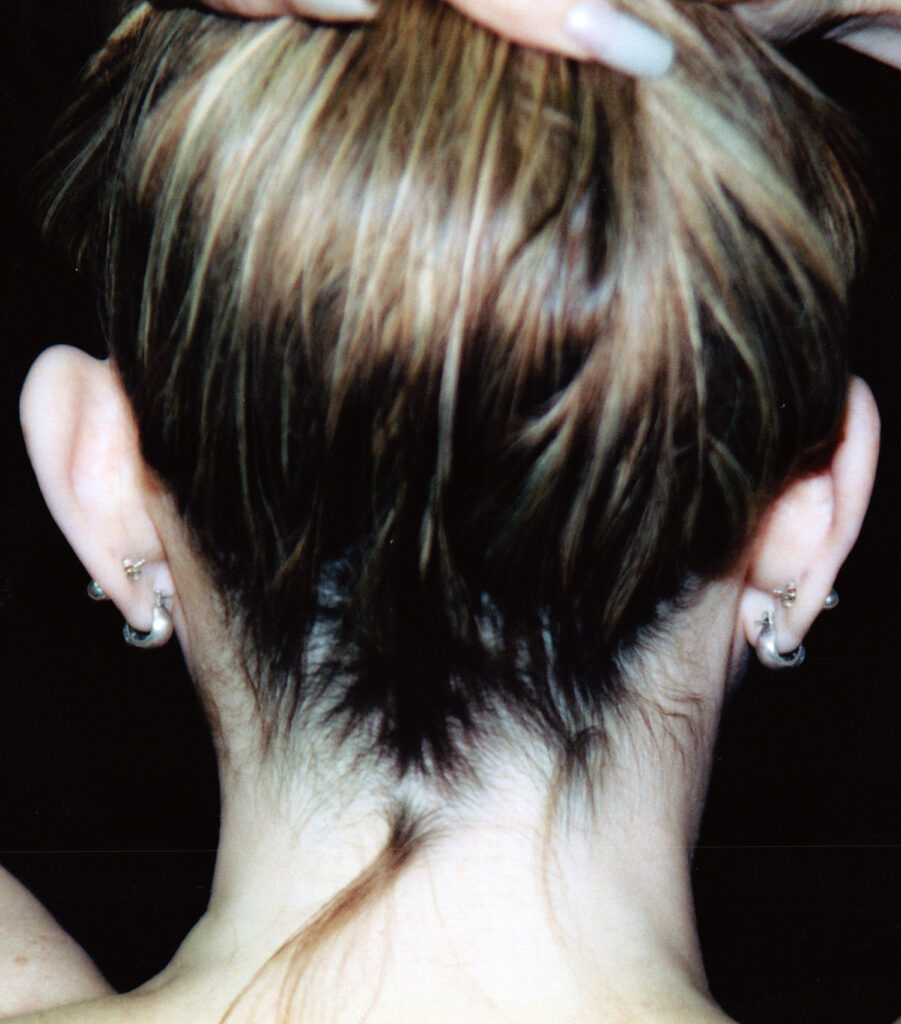 Before Image: Otoplasty - back