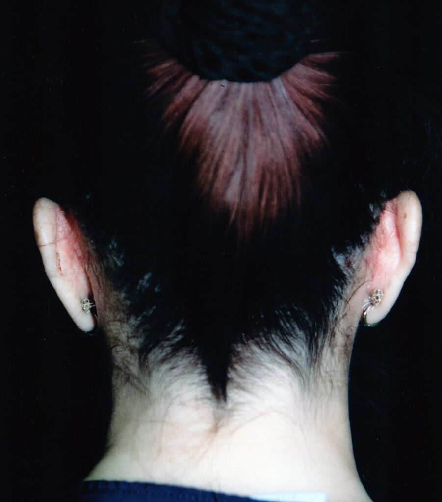 After Image: Otoplasty - back