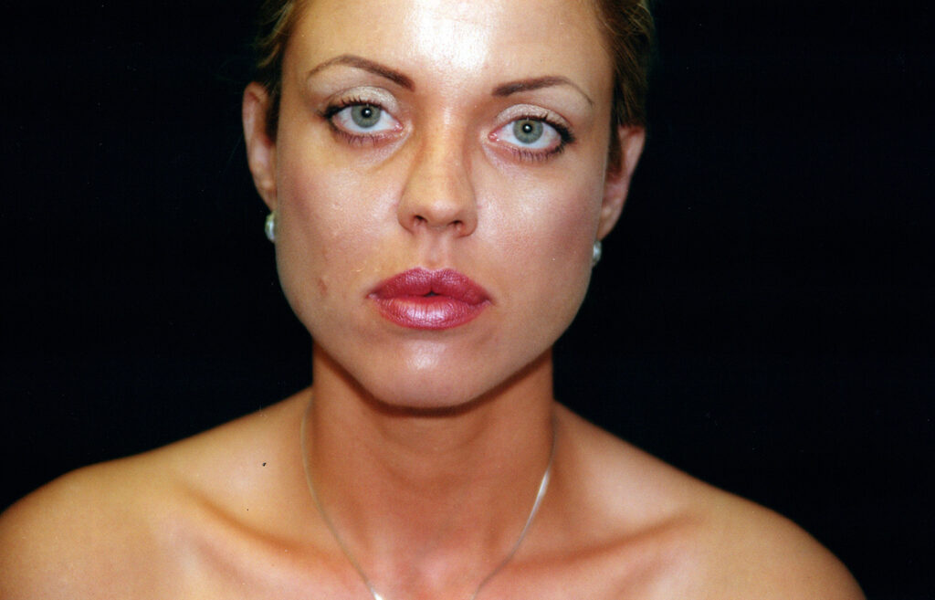 After Image: Neck Liposuction - front