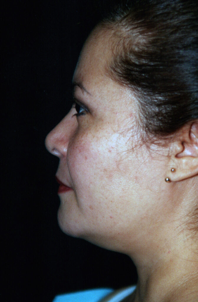 Before Image: Liposuction - left-side