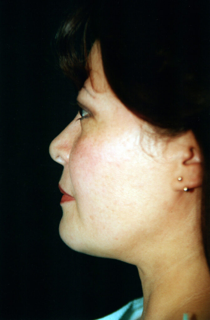 After Image: Liposuction - left-side